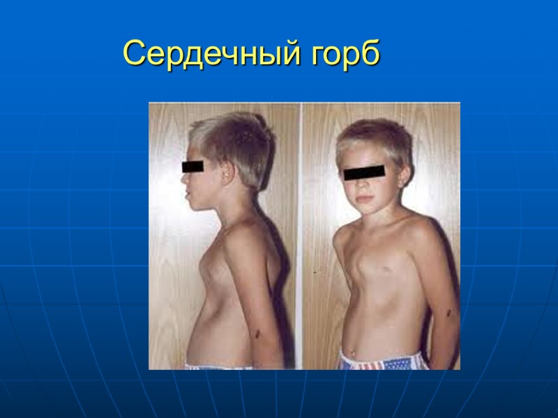 Сердечный горб